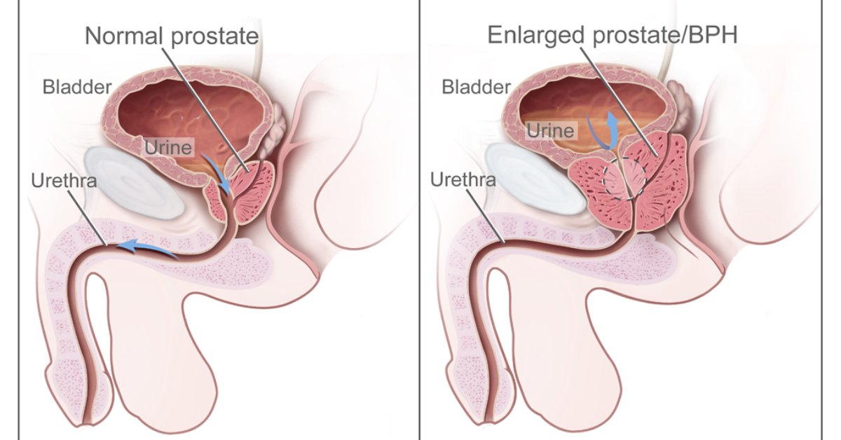 Prostate Health